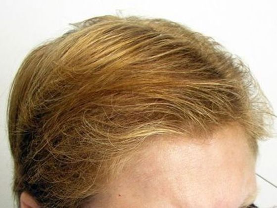 Hair Transplant - Female: Frontal FUT (5) - After female hair transplant
