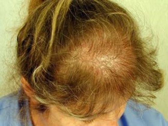 Hair Transplant - Female: Frontal FUT (4) - Before female hair transplant