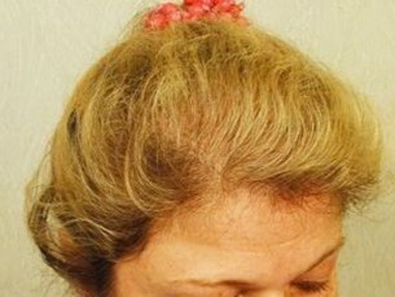 Hair Transplant - Female: Frontal FUT (4) - After female hair transplant