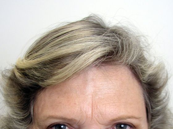 Hair Transplant - Female: Hairline FUT (8) - After female hair transplant