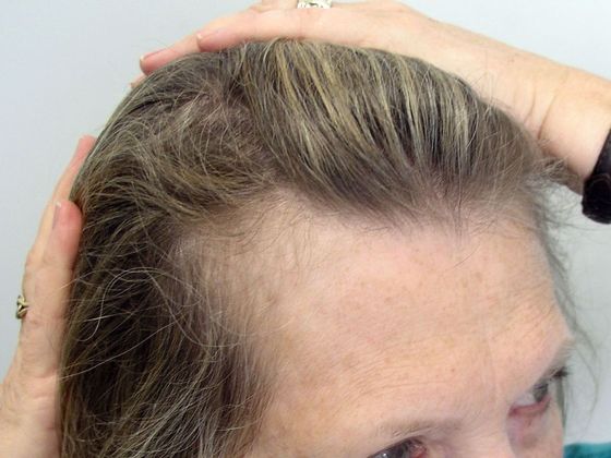 Hair Transplant - Female: Hairline FUT (8) - Before female hair transplant