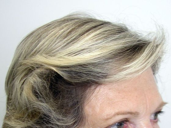 Hair Transplant - Female: Hairline FUT (8) - After female hair transplant