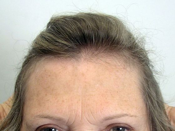 Hair Transplant - Female: Hairline FUT (8) - Before
