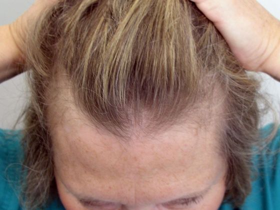 Hair Transplant - Female: Hairline FUT (8) - Before female hair transplant