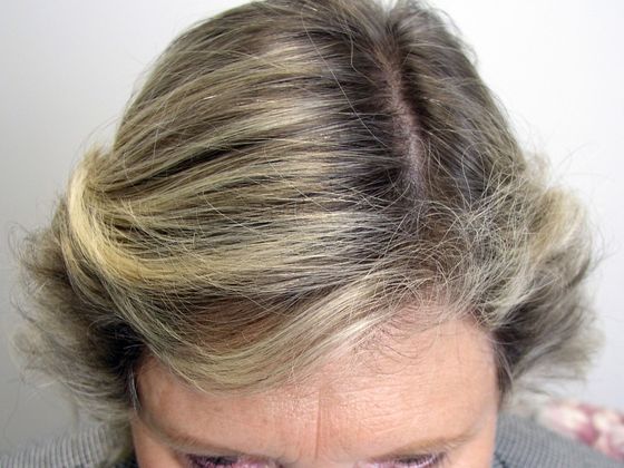 Hair Transplant - Female: Hairline FUT (8) - After female hair transplant