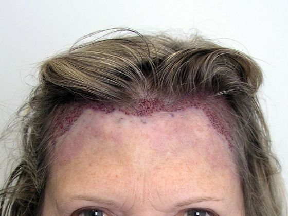 Hair Transplant - Female: Hairline FUT (8) - Immediately post-op hair transplant