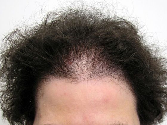 Hair Transplant - Female: Front/Top FUT - Before female hair transplant