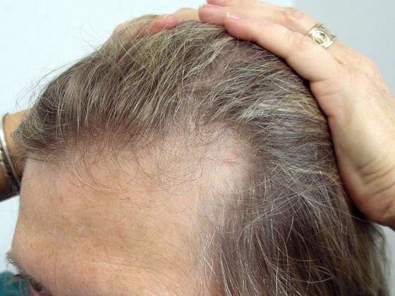 Hair Transplant - Female: Hairline FUT (8) - Before female hair transplant