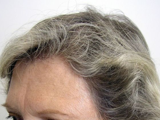 Hair Transplant - Female: Hairline FUT (8) - After female hair transplant