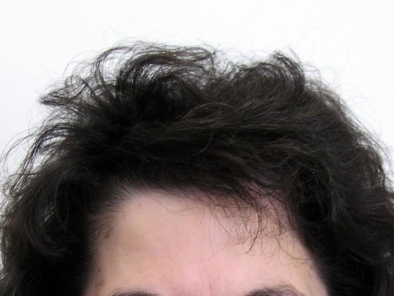 Hair Transplant - Female: Front/Top FUT - After female hair transplant