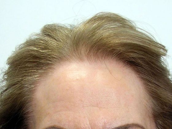 Hair Transplant - Female: Hairline FUT (12) - After female hair transplant