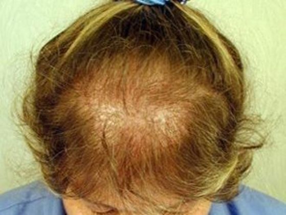 Hair Transplant - Female: Frontal FUT (4) - Before female hair transplant