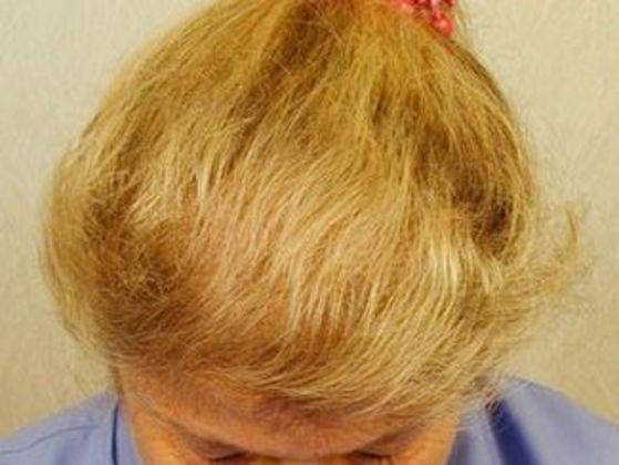Hair Transplant - Female: Frontal FUT (4) - After female hair transplant