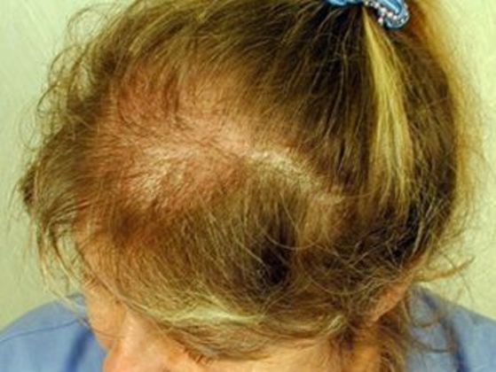 Hair Transplant - Female: Frontal FUT (4) - Before female hair transplant