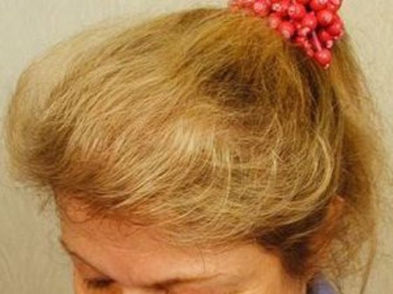 Hair Transplant - Female: Frontal FUT (4) - After female hair transplant