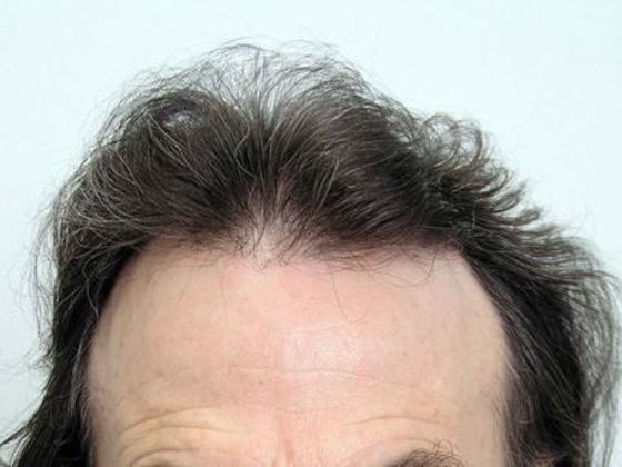 Hair Transplant - Female: Hairline FUT Transgender - Before female hair transplant