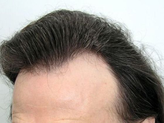 Hair Transplant - Female Hairline FUT Transgender - Before