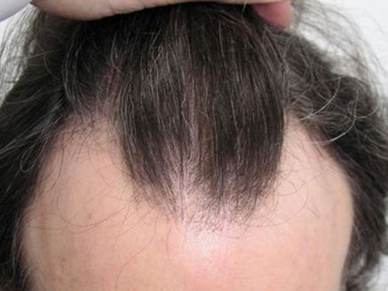 Hair Transplant - Female: Hairline FUT Transgender - Before