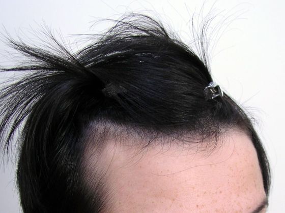 Hair Transplant - Female:  Healing Series (2) Transgender - Before female hair transplant