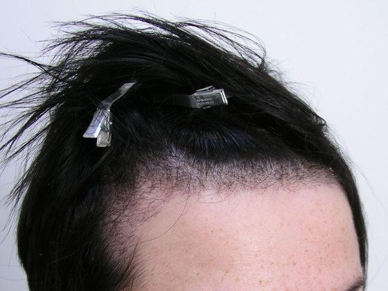 Hair Transplant - Female:  Healing Series (2) Transgender - Post-op female hair transplant