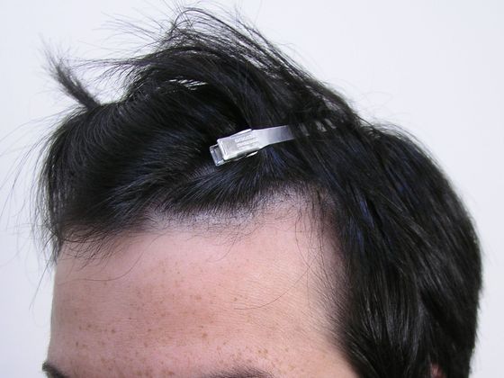 Hair Transplant - Female:  Healing Series (2) Transgender - Before female hair transplant