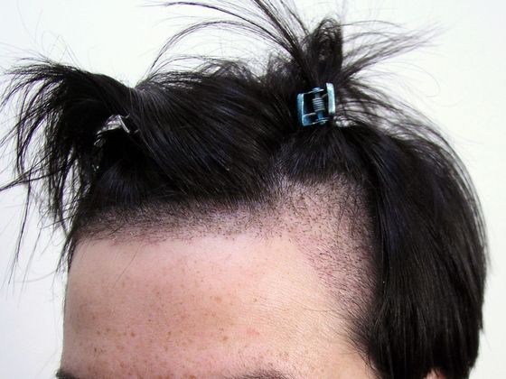 Hair Transplant - Female:  Healing Series (2) Transgender - Post-op female hair transplant