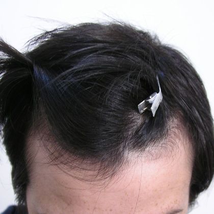 Hair Transplant - Female:  Healing Series (2) Transgender - Before female hair transplant