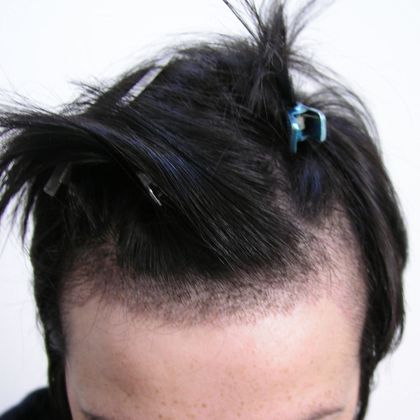 Hair Transplant - Female:  Healing Series (2) Transgender - Post-op female hair transplant