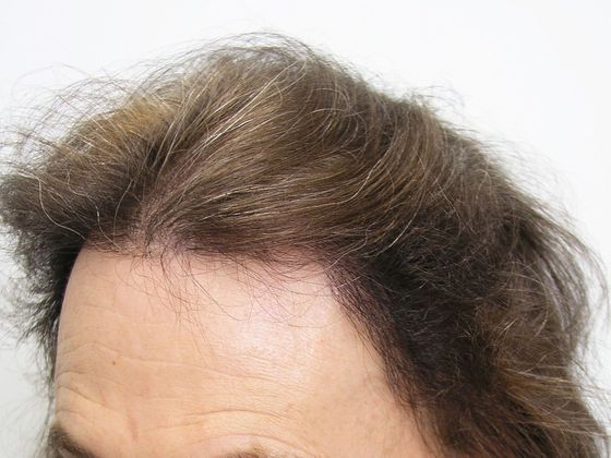 Hair Transplant - Female Hairline FUT Transgender - After