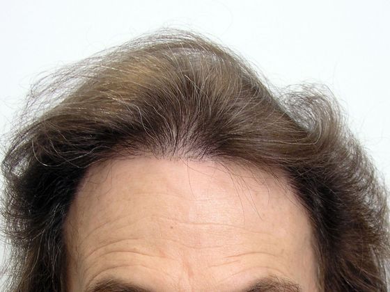 Hair Transplant - Female: Hairline FUT Transgender - After female hair transplant