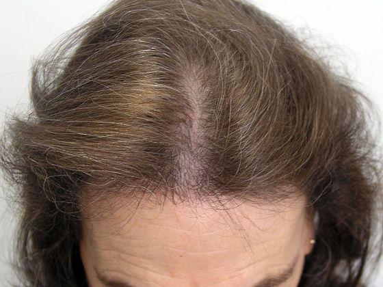 Hair Transplant - Female: Hairline FUT Transgender - After