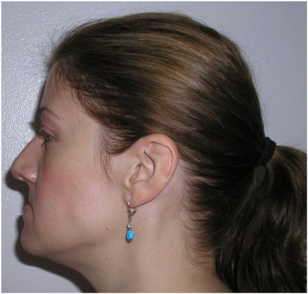 Full Mouth Rehabilitation: Case 2 - Before