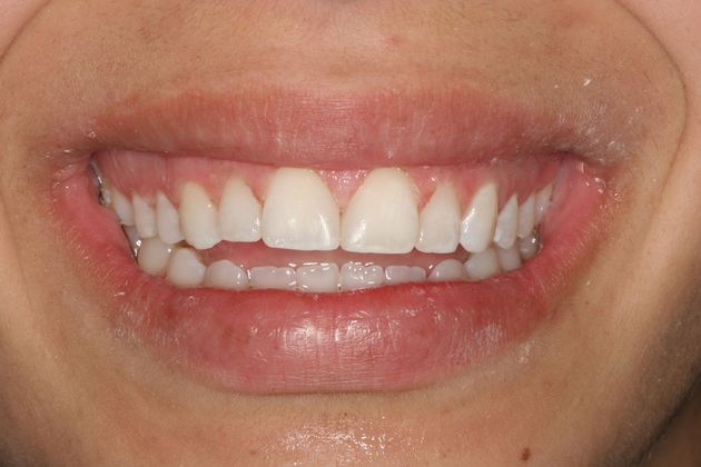 Composite Bonding: Case 2 - After