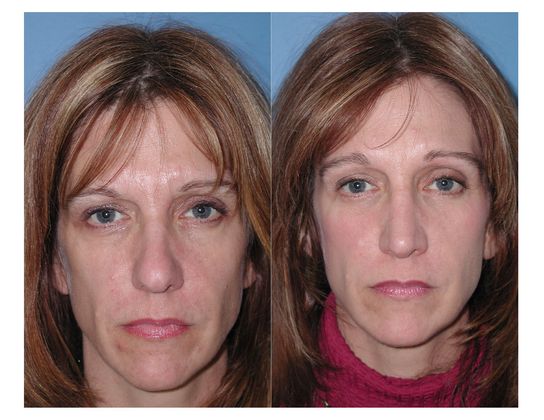 Endoscopic Browlift Case 1