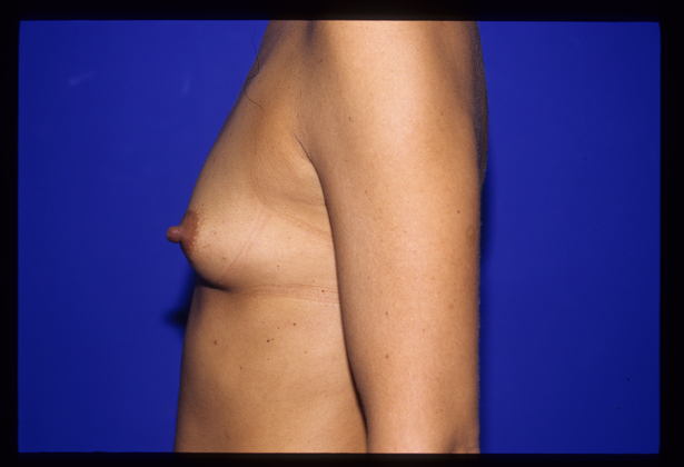 Breast Augmentation / Enhancement Case 1 - Before