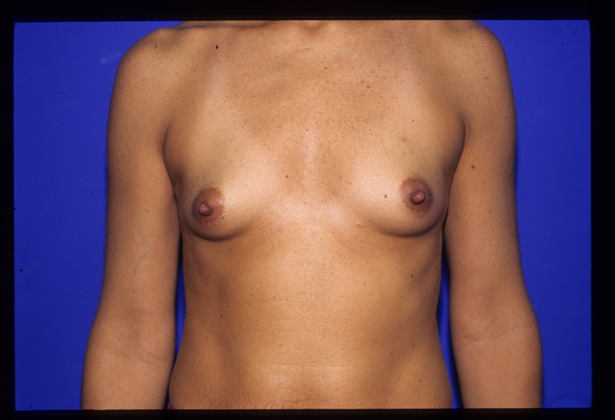 Breast Augmentation / Enhancement: Case 1 - Before