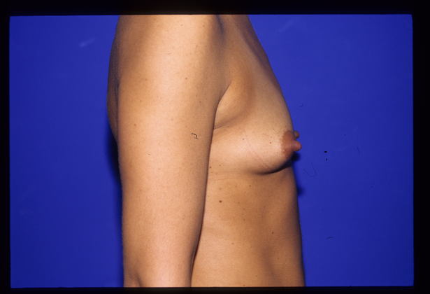 Breast Augmentation / Enhancement: Case 1 - Before