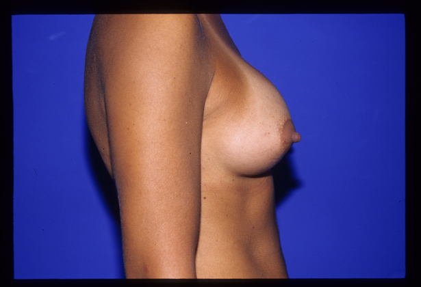 Breast Augmentation / Enhancement: Case 1 - After