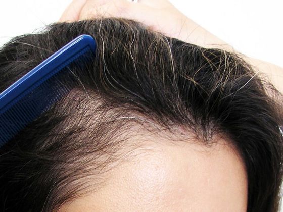 Hair Transplant - Female: Hairline FUT (11) - Before female hair transplant