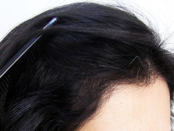 Hair Transplant - Female: Hairline FUT (11) - After female hair transplant