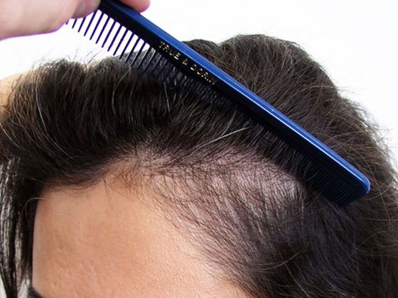 Hair Transplant - Female: Hairline FUT (11) - Before female hair transplant