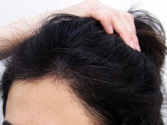 Hair Transplant - Female: Hairline FUT (11) - After female hair transplant