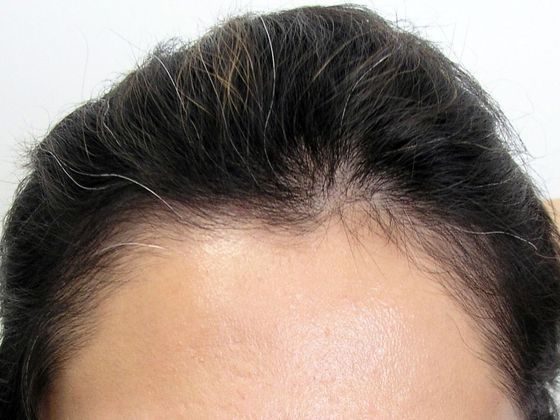 Hair Transplant - Female: Hairline FUT (11) - Before female hair transplant