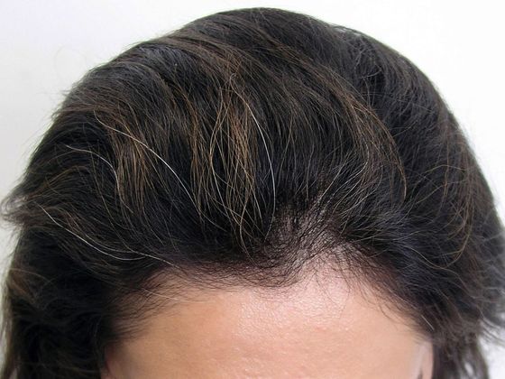Hair Transplant - Female: Hairline FUT (11) - Before female hair transplant