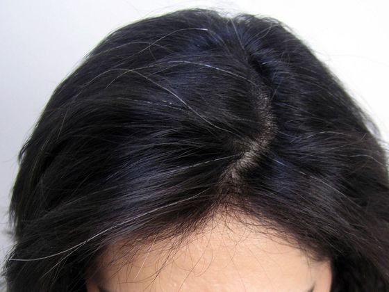 Hair Transplant - Female: Hairline FUT (11) - After female hair transplant