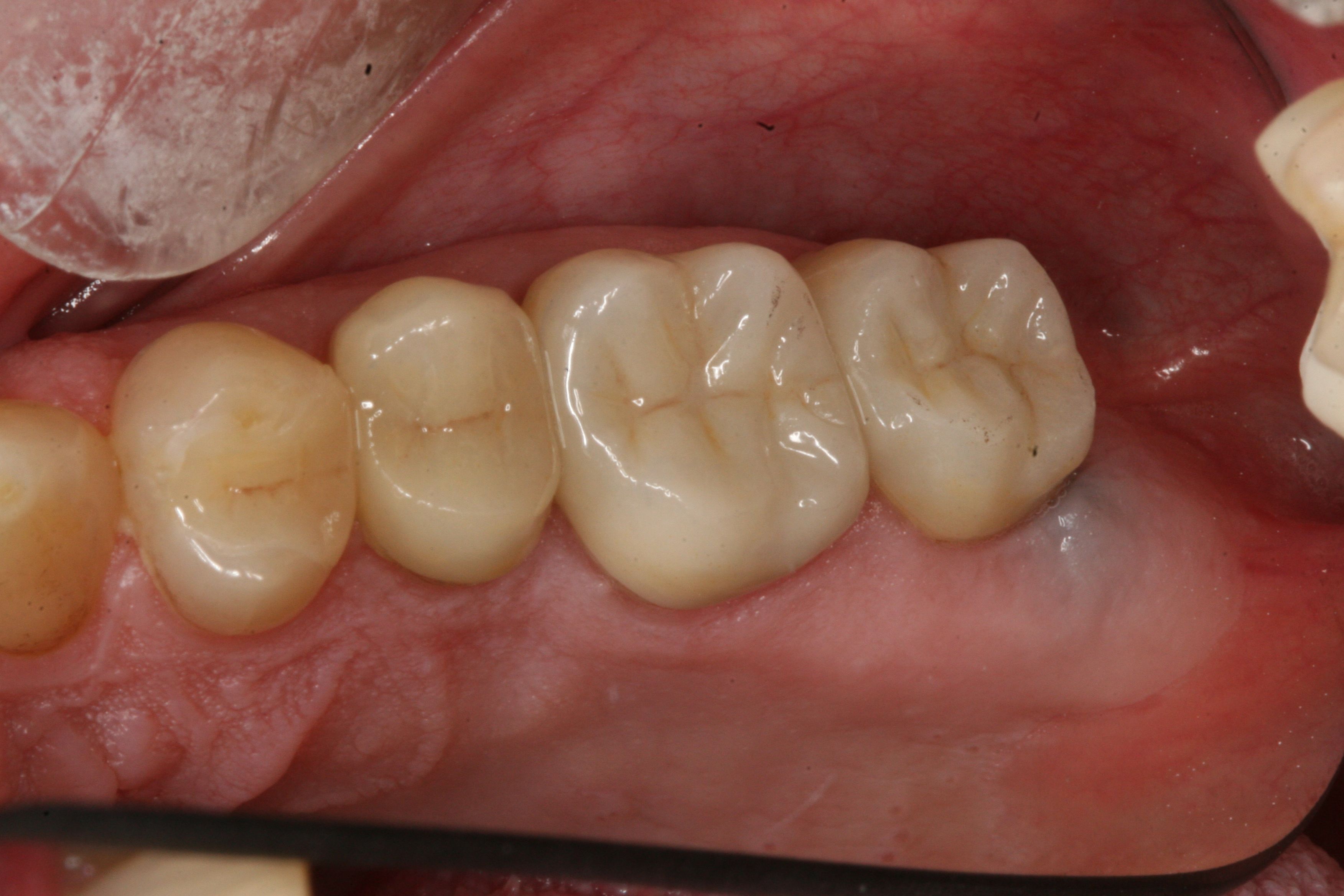 Porcelain Inlays, Onlays and Crowns - Inlays / Onlays - Before and ...