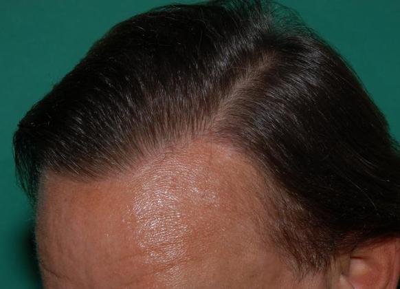 Hair Loss Surgery: 3260 Frontal-Midscalp Restoration - Postop Left View