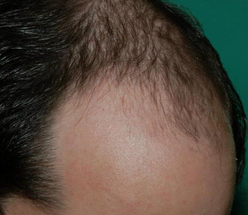 Hair Loss Surgery: 4563 Graft Frontal-Midscalp Restoration - Preop Right View