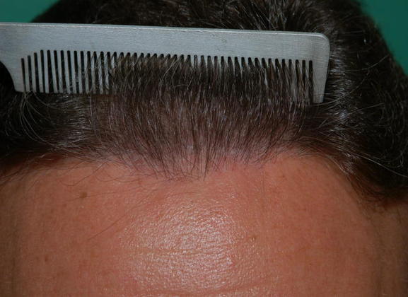 Hair Loss Surgery: Plug Repair with Forehead Advancement and 3220 Grafts - Postop Front Close-Up