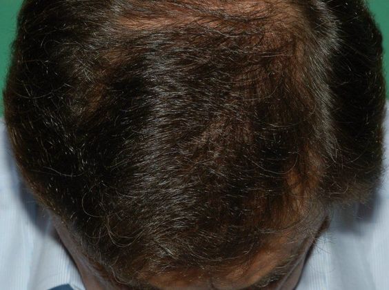 Hair Loss Surgery: 3357 Graft Hairline Restoration - Postop Top View
